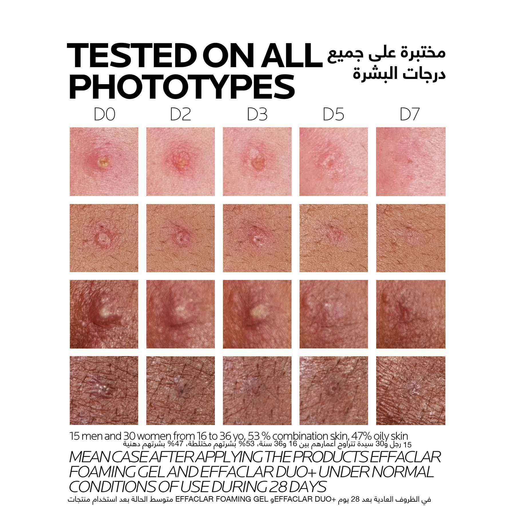 La Roche-posay Effaclar Duo+m 40ml Anti-imperfections Triple Corrective Care for Oily and Acne-prone Skin, Powered by Microbiome Science. - Image 5