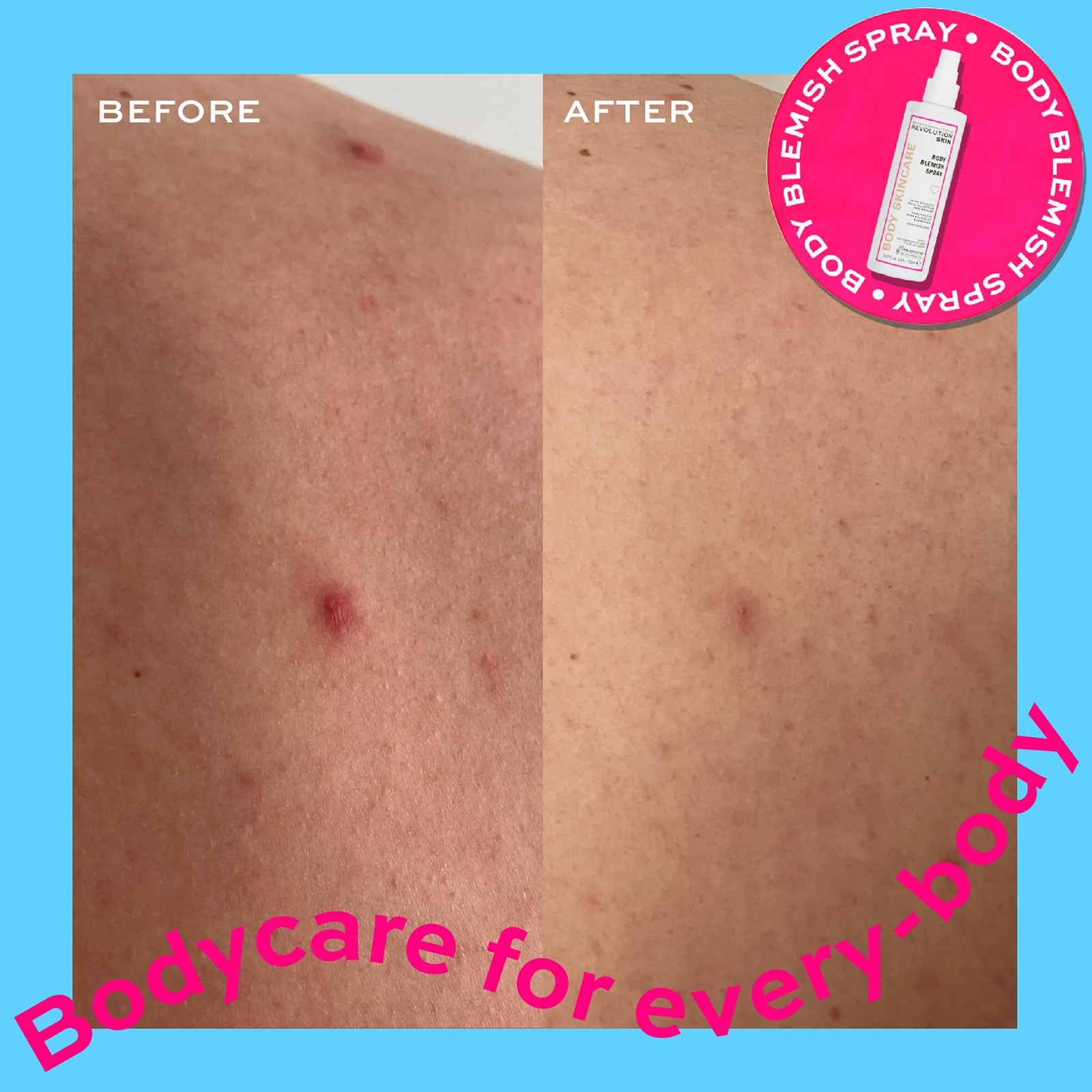 Revolution Skincare Body Blemish Spray 150ml - Image 3